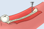 大口式（OAM）インプラントの手術手順のイメージ2