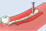 大口式（OAM）インプラントの手術手順のイメージ3