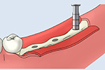 大口式（OAM）インプラントの手術手順のイメージ4
