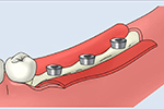 大口式（OAM）インプラントの手術手順のイメージ5