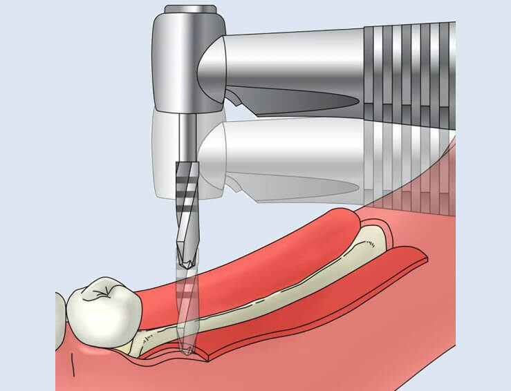 大口式（OAM）インプラントの手術手順のイメージ6