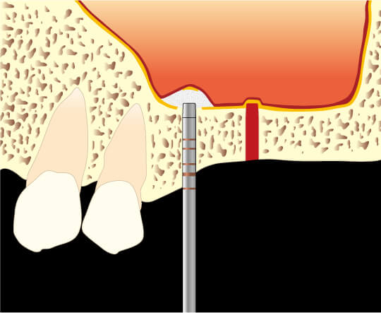 骨高が低い難症例 上顎の奥歯への対応法図1