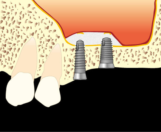 骨高が低い難症例 上顎の奥歯への対応法図2