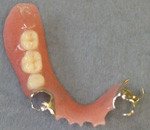 部分入れ歯（プラスティック樹脂）イメージ