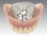 総入れ歯（金属床）イメージ