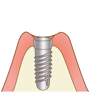 implant004