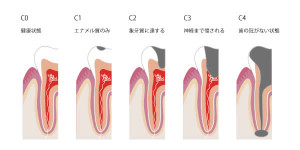 caries